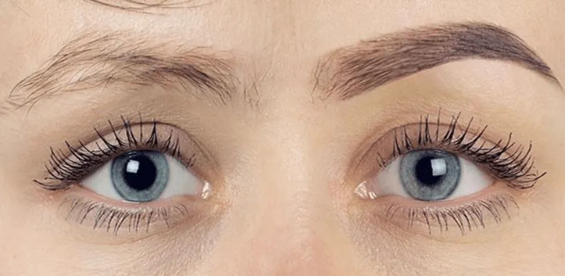 Alopesi Olan Çocuklarda Kaş Uygulaması